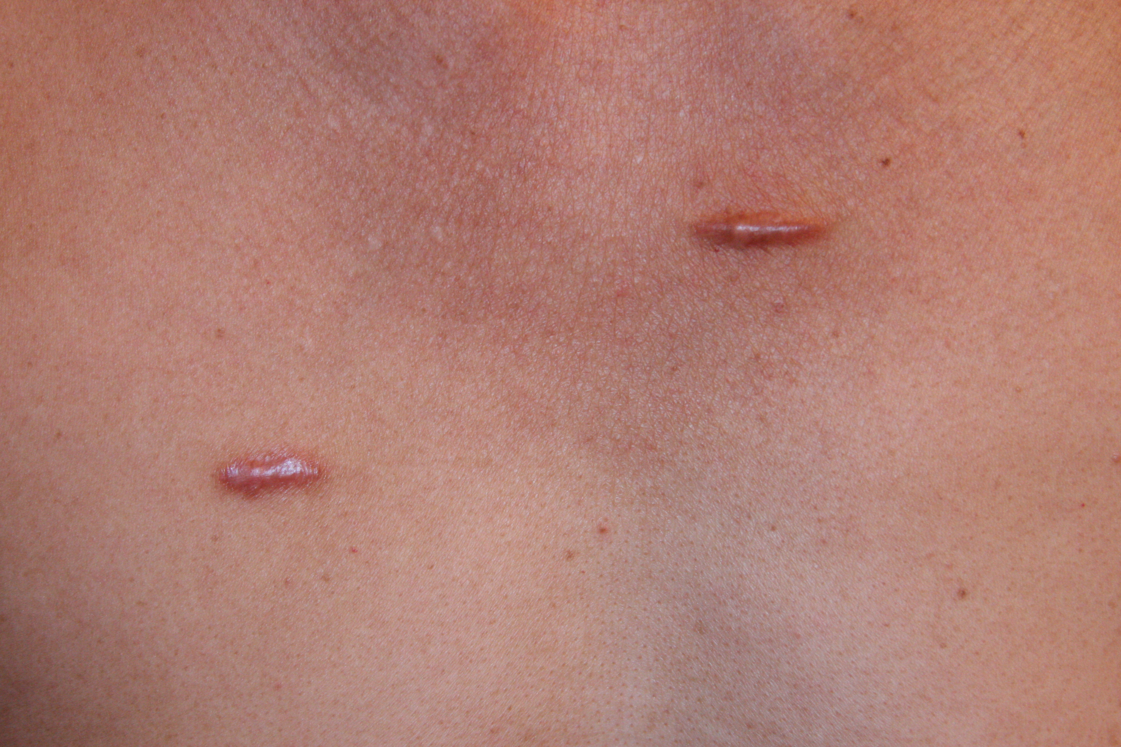 Keloid Scar