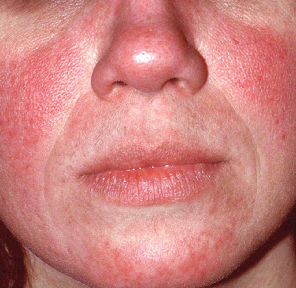 Rosacea