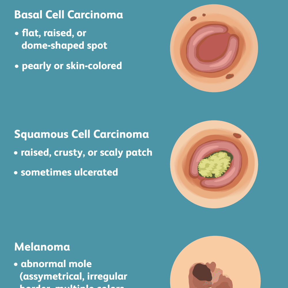 Skin Cancer