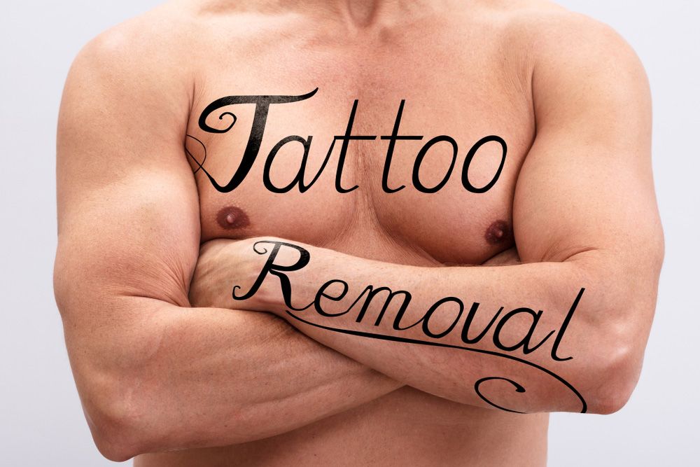 tattoo removal